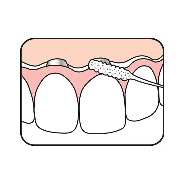 TePe Bridge and Implant Floss Οδοντικό Νήμα για Γέφυρες και Εμφυτεύματα 30 τμχ