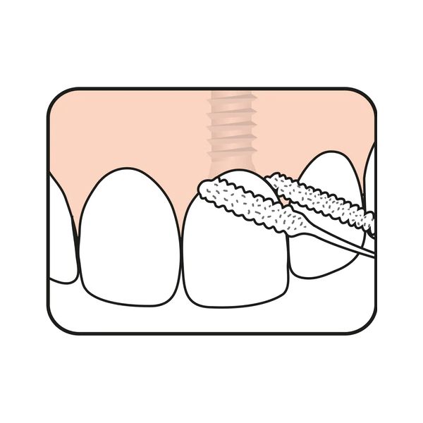 TePe Bridge and Implant Floss Οδοντικό Νήμα για Γέφυρες και Εμφυτεύματα 30 τμχ