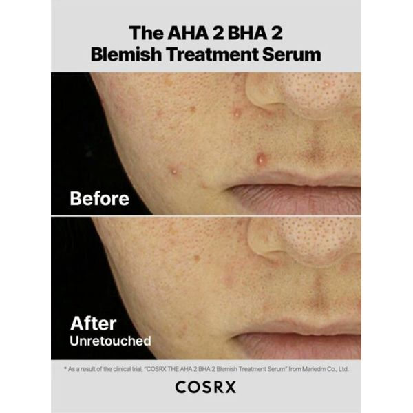 COSRX The AHA 2 BHA 2 Blemish Treatment Serum Ορός με Οξέα για Τοπική Χρήση 50 gr