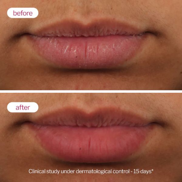 Novexpert Lip Up Lip Balm Αύξησης Όγκου Χειλιών με Υαλουρονικό Οξύ 8 ml