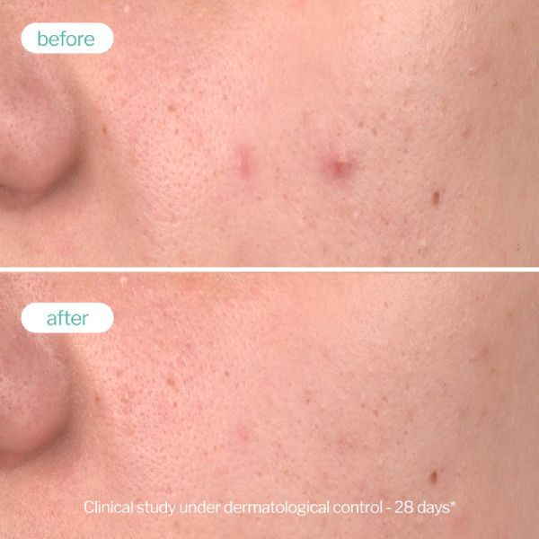 Novexpert Trio Zinc Clear Skin Peeling Προσώπου κατά των Ατελειών για Κανονικό έως Λιπαρό Δέρμα 30 ml